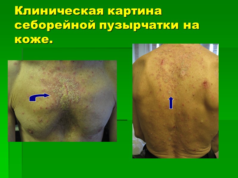 Клиническая картина себорейной пузырчатки на коже.